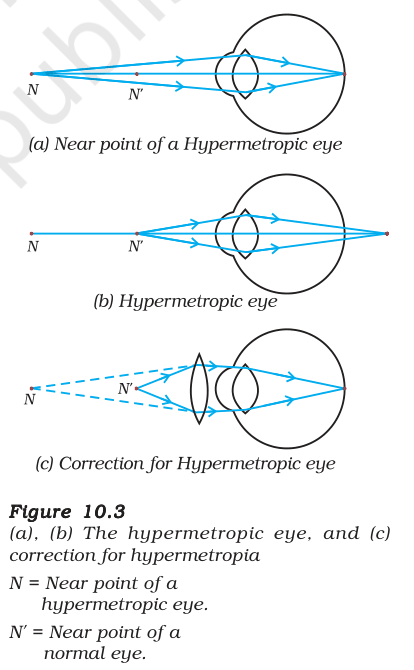 Ray diagrams of a hypermetropic eye: near point, image formed behind the retina, and correction with a convex lens
